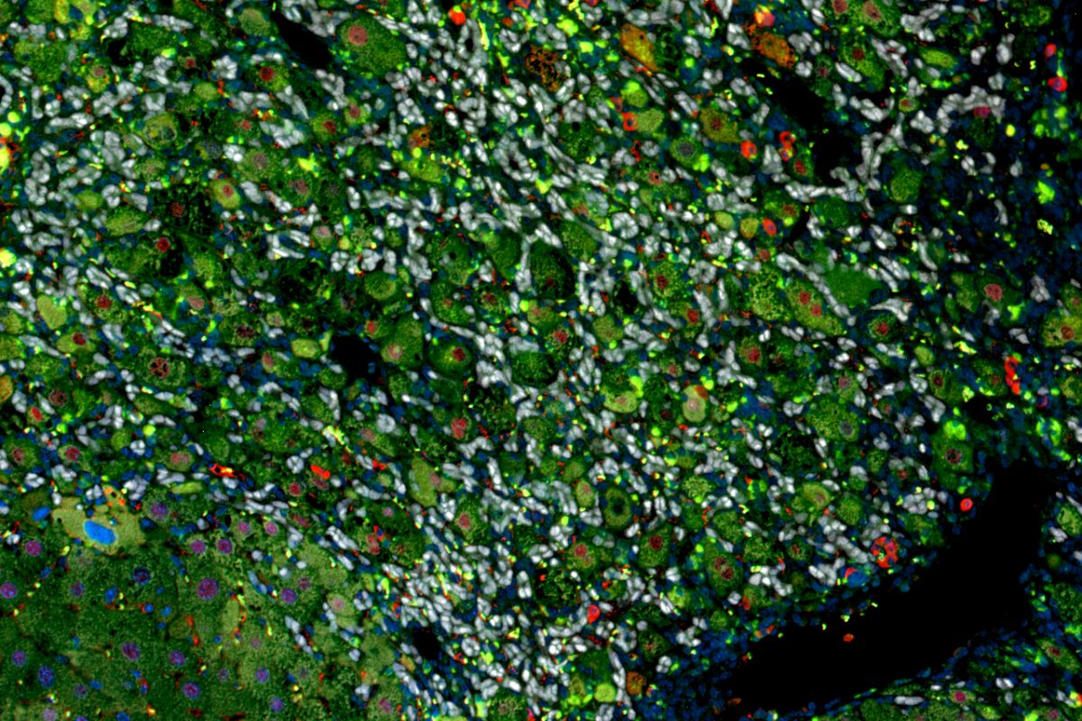 Imagen de un h�gado de ratón con cirrosis en la que distintos tipos de células del h�gado han sido marcadas con fluoróforos que se distinguen en los colores blanco, verde y rojo.FOTO: Nabil Djouder. CNIO.
